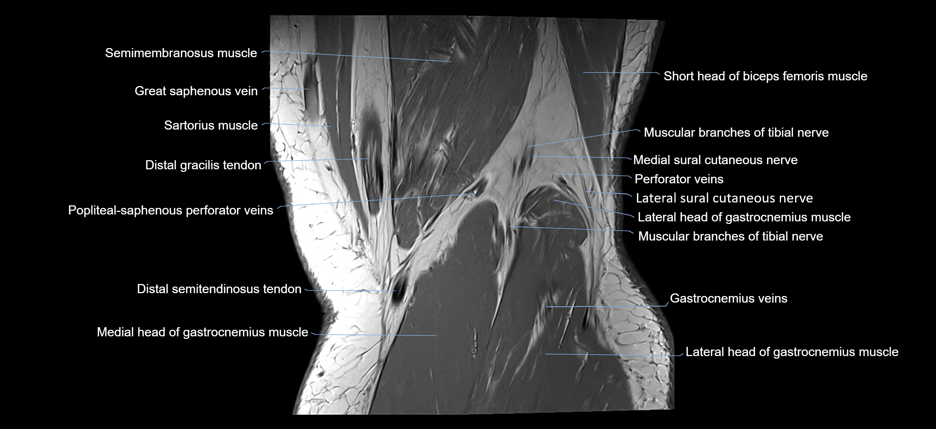 MRI knee coronal cross sectional anatomy labelled 3T radiology  image-04001-00038.webp